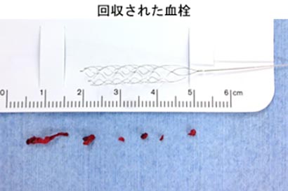 脳血管内治療15