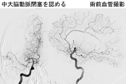 脳血管内治療13