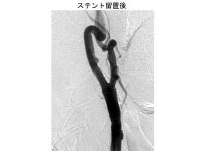 脳血管内治療17