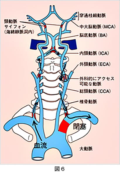 脳血管内治療18