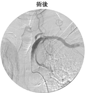 脳血管内治療21