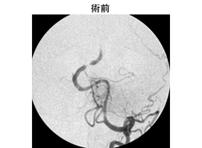 脳血管内治療22