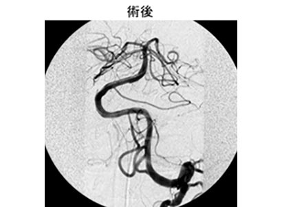 脳血管内治療23