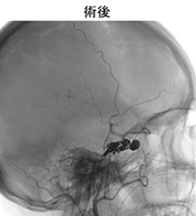 脳血管内治療25