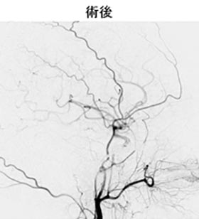 脳血管内治療26