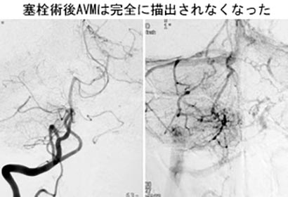 脳血管内治療32