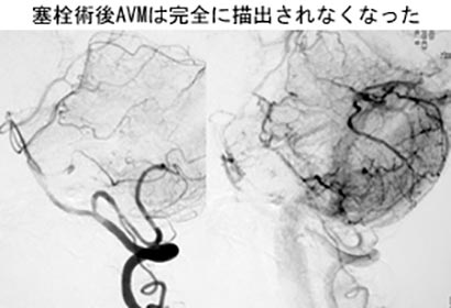 脳血管内治療31