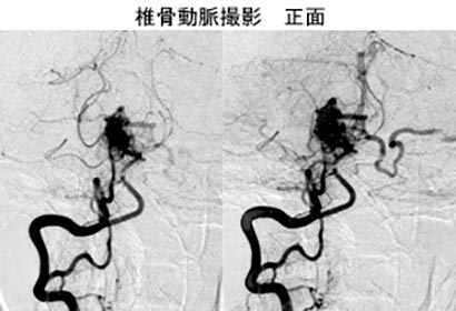 脳血管内治療30