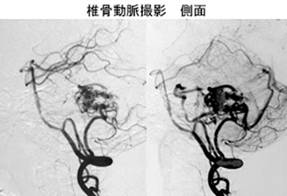 脳血管内治療29