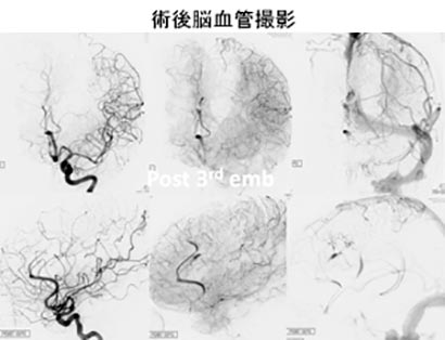 脳血管内治療35