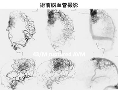 脳血管内治療34