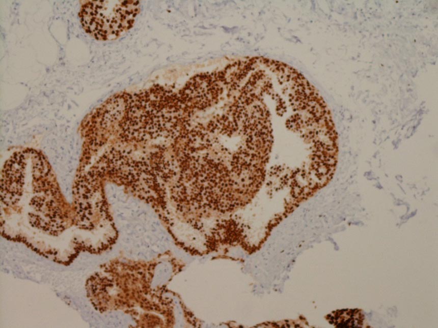 乳がんエストロゲンレセプター組織標本