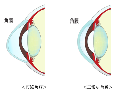 角膜クロスリンキング手術